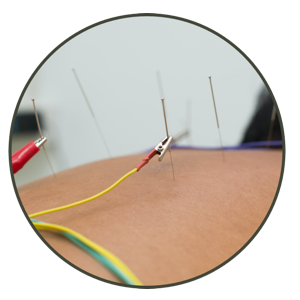 palms acupuncture treatment electro acupuncture